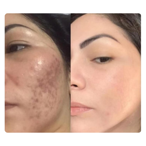 Peeling de algas