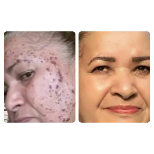 Melanose populosa nigra-verruga negra